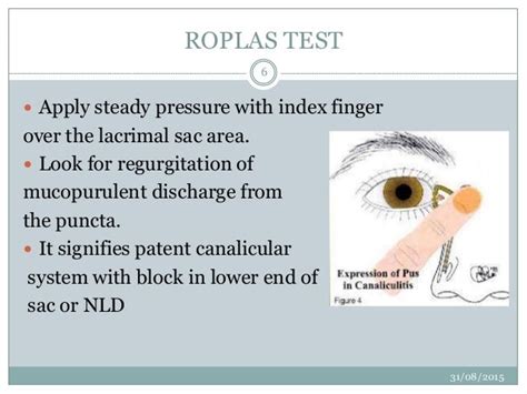 tear duct patency test|Canalicular Obstruction .